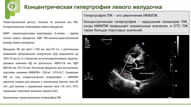 ГиП занятие 3 - типы геометрии ЛЖ и структурное ремоделирование