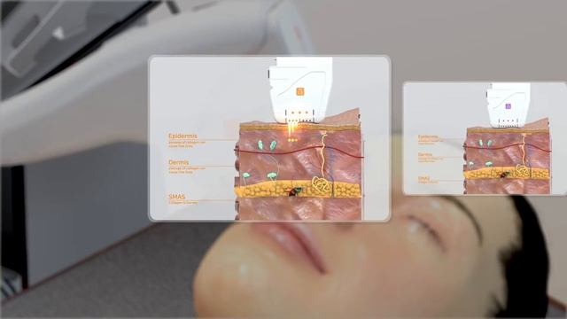 Ультразвуковой СМАС лифтинг на аппарате UCOS смотреть онлайн