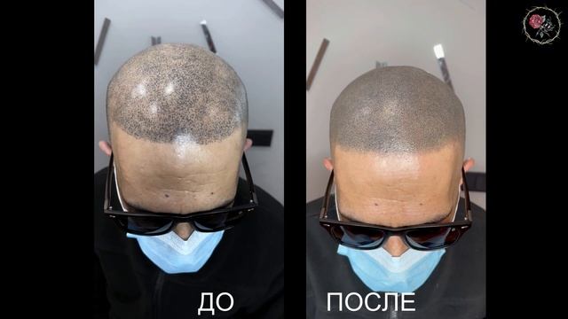Исправление трихопигментации, сделанной в студии перманентного макияжа. Scalp Micropigmentation смотреть онлайн