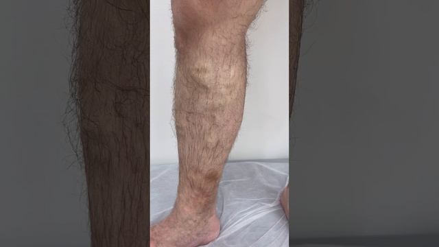 Варикоз и трофические расстройства на ноге. Необходимо операция по удалению варикоза. Флеболог смотреть онлайн