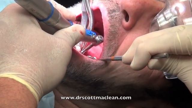 Dental Implant Surgery - Help for Surgery - explicit смотреть онлайн
