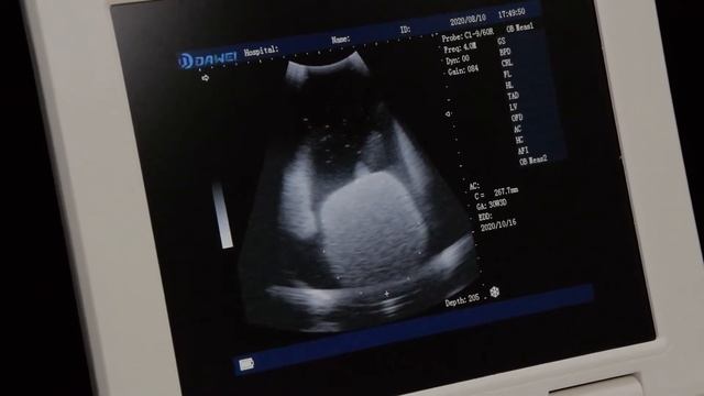 How to do obstetric measurements on an ultrasound machine？ смотреть онлайн