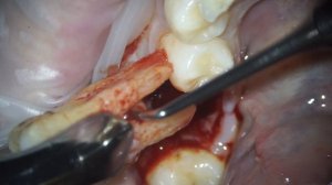 Треснул зуб / удаление зуба 36 #стоматология #пломба #имплант #кариес #dental #dentist #dentistry