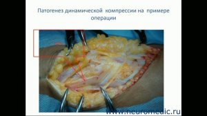 Компрессионная невропатия малоберцового нерва. Синдром фибулярного канала.