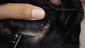 Почесывание больших хлопьев перхоти #902