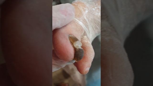 Возрастные ногти- изменения ногтевой пластины. #Подология