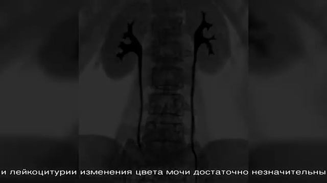 Песок в моче смотреть онлайн