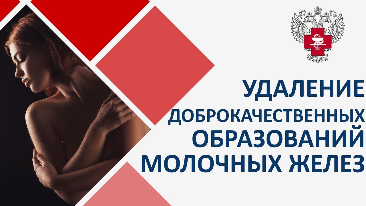 Доброкачественная опухоль молочной железы.  Лечение доброкачественной опухоли молочной железы