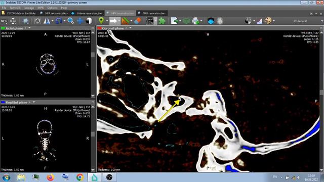 МСКТ ГОЛОВЫ , АНГИОГРАФИЯ . Что то типа лекции . смотреть онлайн