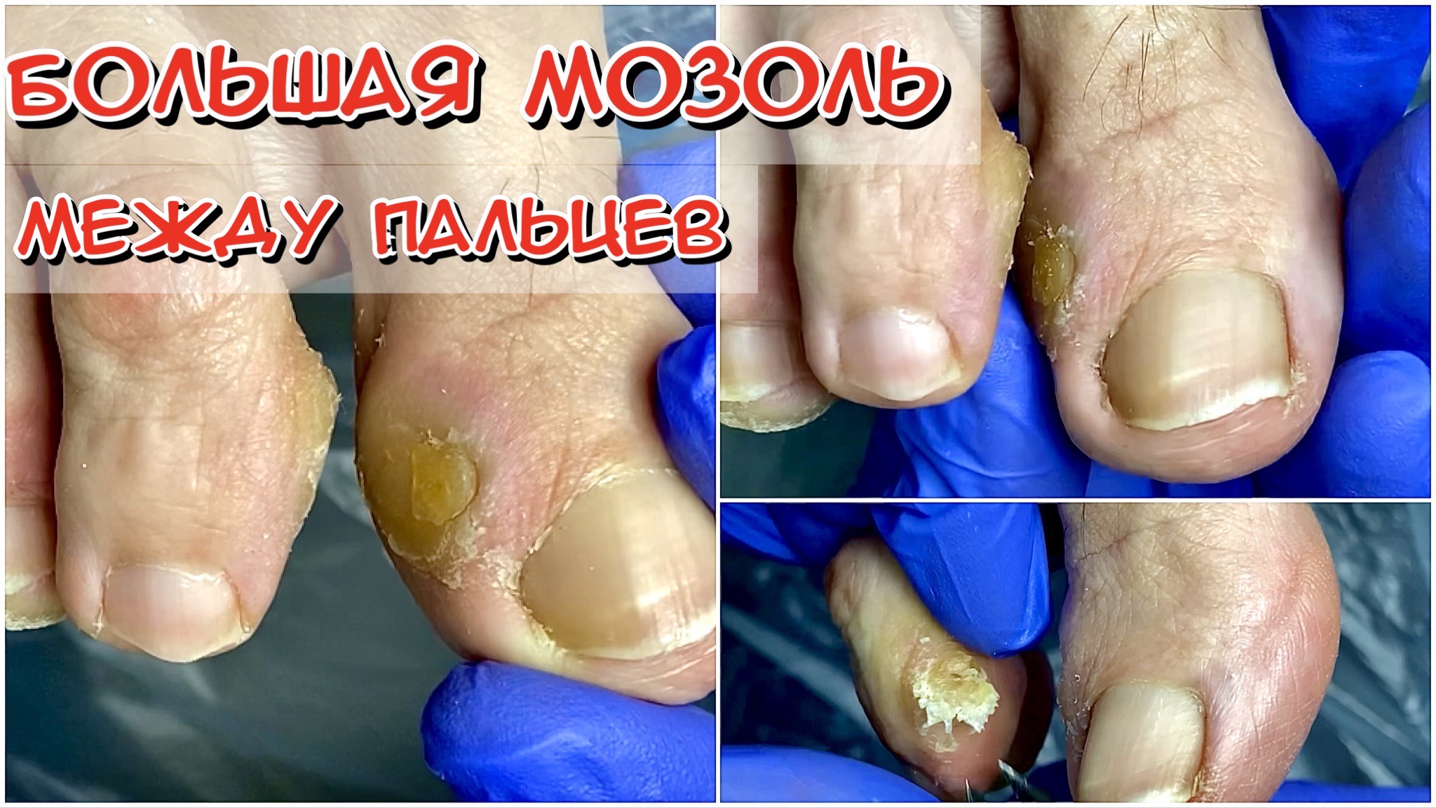 Большая мозоль между пальцев смотреть онлайн