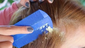 Removal Dandruff Flakes With Lice Comb | Psoriasis Flakes Scalp Easy Scratching Dandruff Off Scalp