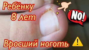 Вросший ноготь?⚠️?? • Ребёнку 8 лет??