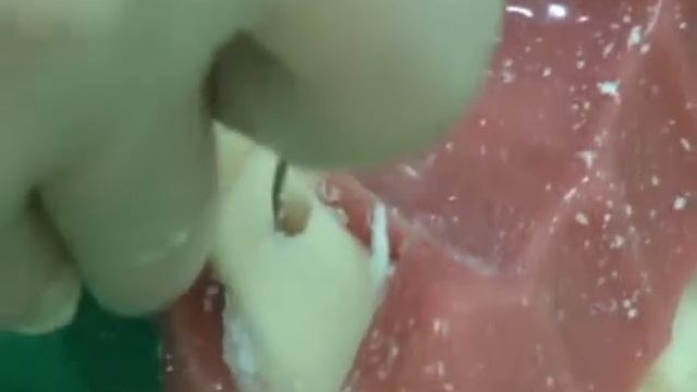 Sinus Lift Kit 1 смотреть онлайн