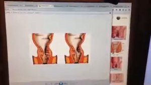 Дезартеризация и лазерная вапоризация геморроя простыми словами