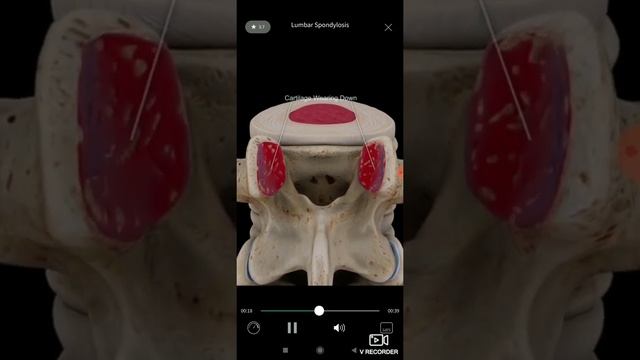 Спондилез поясничного отдела позвоночника. 3D анатомия. смотреть онлайн