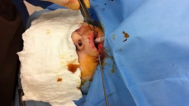 Silicone Lip Augmentation смотреть онлайн