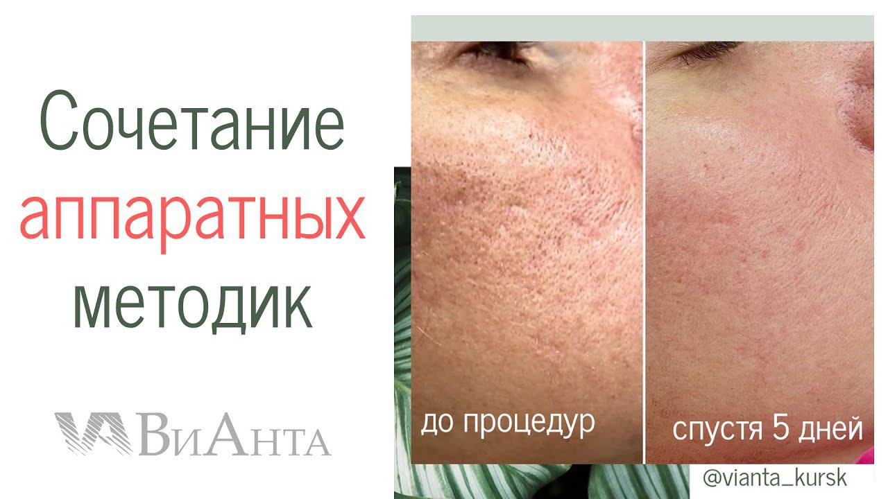Новая молодая и упругая кожа через 5 дней!