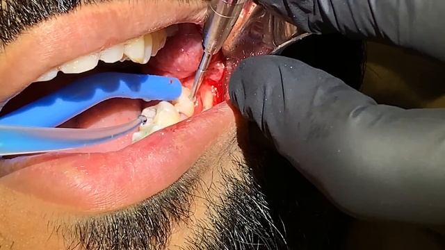 Surgical Wisdom Tooth Extraction (LL8) by Specialist Oral Surgeon Dr. Abdul Dalghous смотреть онлайн