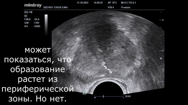 УЗИ в урологии. Не забываем про куперит смотреть онлайн