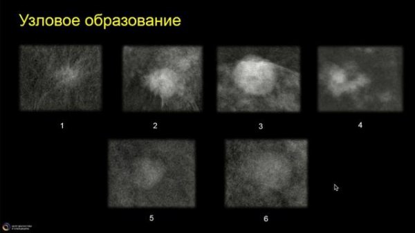 Рекомендации BI-RADS для Контрастной маммографии