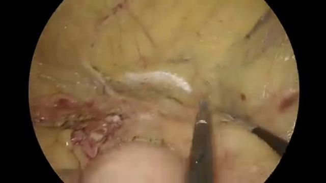 IPOM Plus for Suprapubic Hernia (RIF) - Dr Abhilash Nali, Hyderabad смотреть онлайн