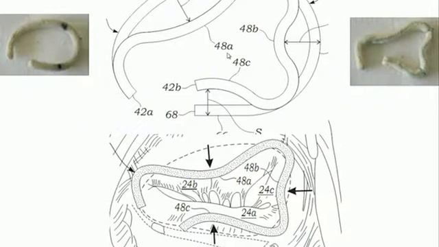 Ottavio R Alfieri. Tricuspid regurgitation in different clinical scenarios смотреть онлайн