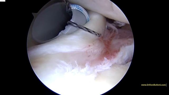 R Shoulder Biceps Tenodesis 11102016SW