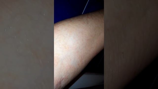 1 Псориаз сдался за 10 дней !!!  Делюсь впечатлениями