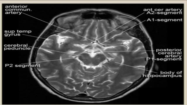 mri of brain t2 study смотреть онлайн