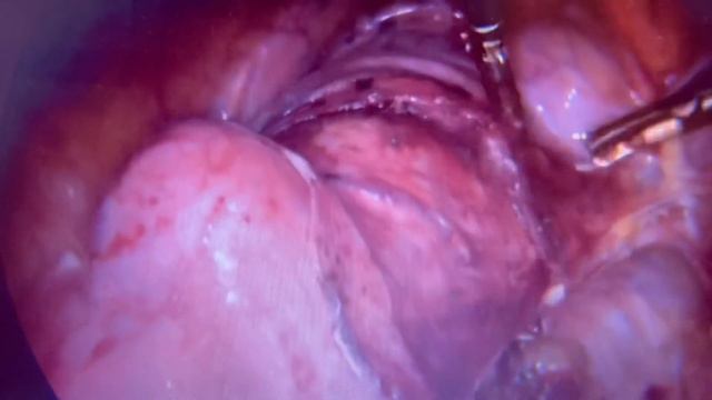 My third TLH using bipolar and LigaSure. Лапароскопическая экстирпация матки. смотреть онлайн