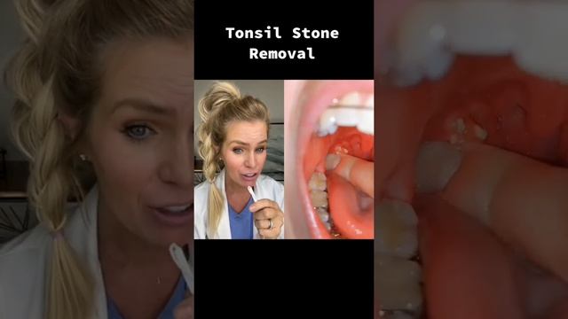 Big juicy tonsil stone removal! #tonsilstones #dentist #tonsils смотреть онлайн