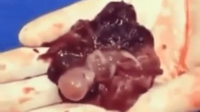 Выкидыш Плод 12 недель смотреть онлайн