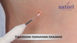Удаление папиллом и других новообразований кожи плазмой