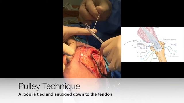 Distal Triceps Rupture Repair: The Triceps Pulley-Pullover Technique смотреть онлайн
