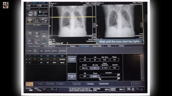 CT PULMONARY ANGIOGRAM |CTPA| Bolus Tracking|Canon Aquilion Prime SP