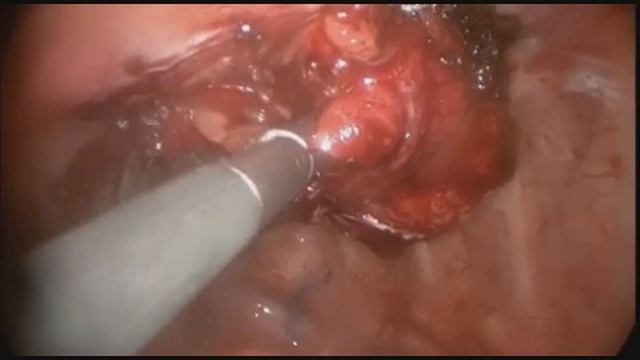 Липома грудной стенки.mp4