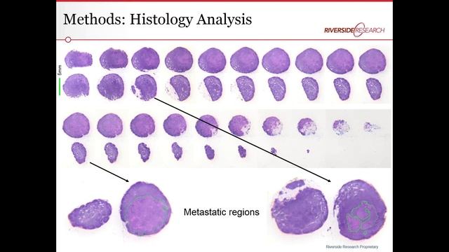 Detecting Cancer in Lymph Nodes Using Quantitative Ultrasound смотреть онлайн
