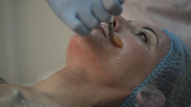 Радиоволновой лифтинг (RF-лифтинг) - Клиника "Ирина" смотреть онлайн