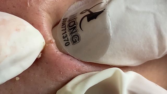 Make your Acne Treatment Huong Da Nang | 423 # acne 2022 смотреть онлайн