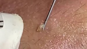 Выдавливание прыщей с лица | как выдавить угри с лица в спа салоне | удалить жир с лица