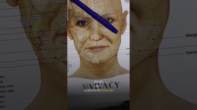 Морщины марионетки