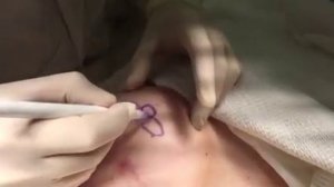 Реконструкция соска. Мастэктомия. Реконструкция молочной железы. Рак молочной железы.