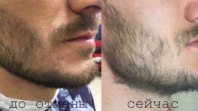 Бритье после отмены миноксидила. 5 месяцев после смотреть онлайн