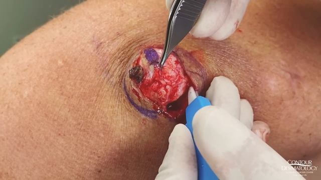 A SURPRISE Inside This Big Blackhead | CONTOUR DERMATOLOGY