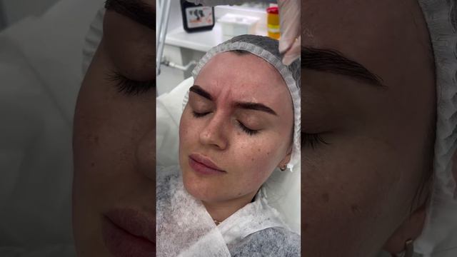 Как проходит процедура ботокса💁🏼♀️
#лазернаяэпиляция #депиляция #электроэпиляция #косметология смотреть онлайн