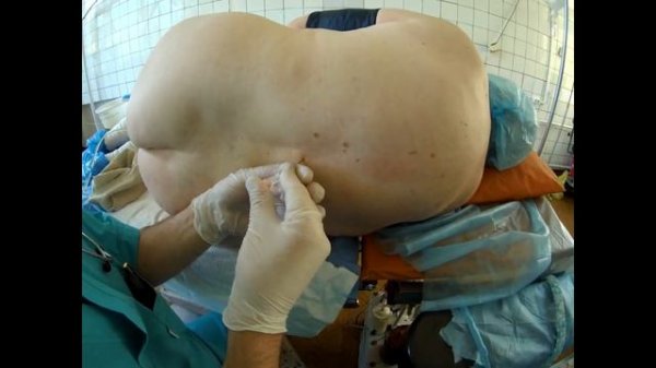 Epidural anesthesia/Эпидуральная анестезия