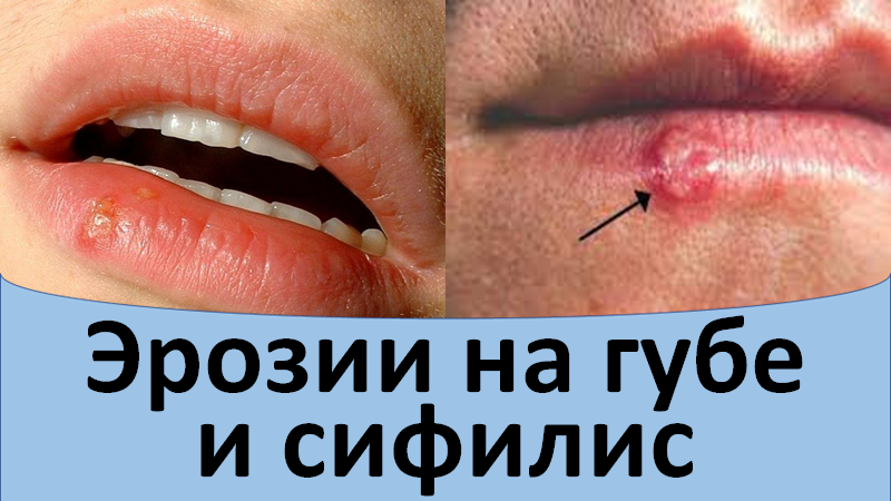 Эрозии на губе при сифилисе смотреть онлайн