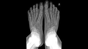 Укладка стопы с нагрузкой