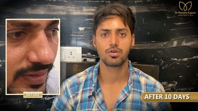 Rhinoplasty in Delhi | Extremely Happy & Highly Satisfied Patient | Testimonial & Review смотреть онлайн