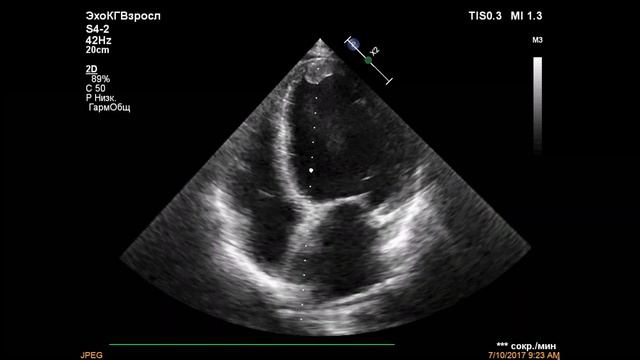 Дилатационная КМП, верхушечный тромб левого желудочка смотреть онлайн